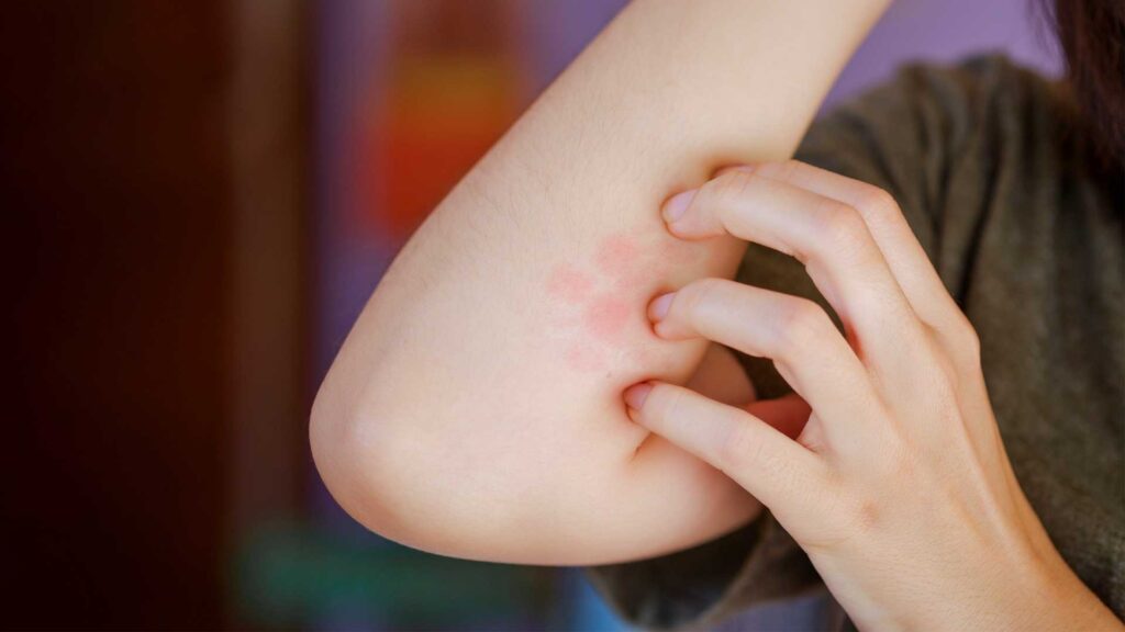 Itchiness and Rashes are the Symptoms of Scabies.